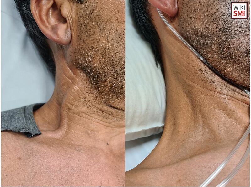 File:JVD jugular venous distension.jpeg