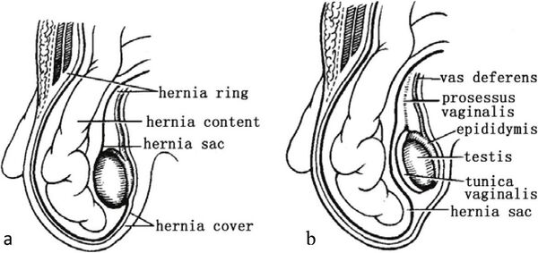 inguinal-hernia-wikism-sports-medicine-wiki