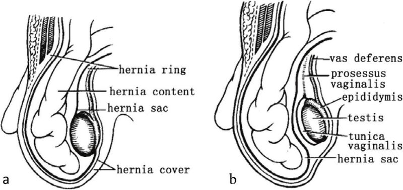 File:Congenital acquired inguinal hernia.jpg