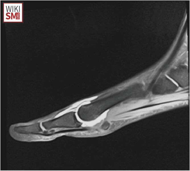 File:Turf toe MRI.jpeg