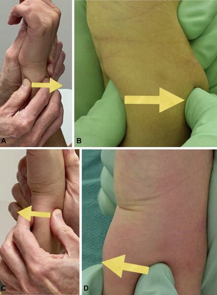 File:Dorsopalmar stress test.jpg