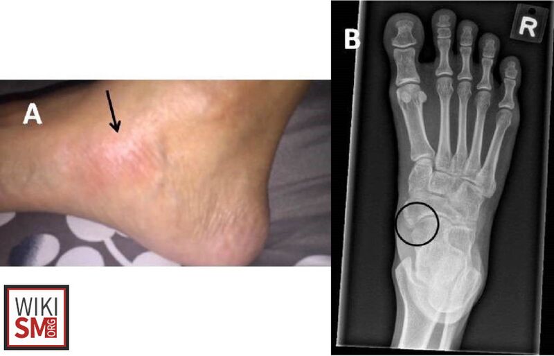 File:Accessory navicular syndrome.jpeg