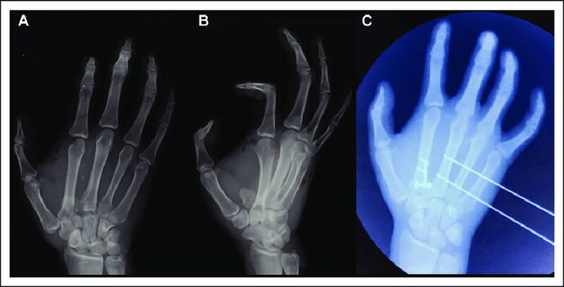 File:Fourth carpometacarpal joint dislocation.jpg
