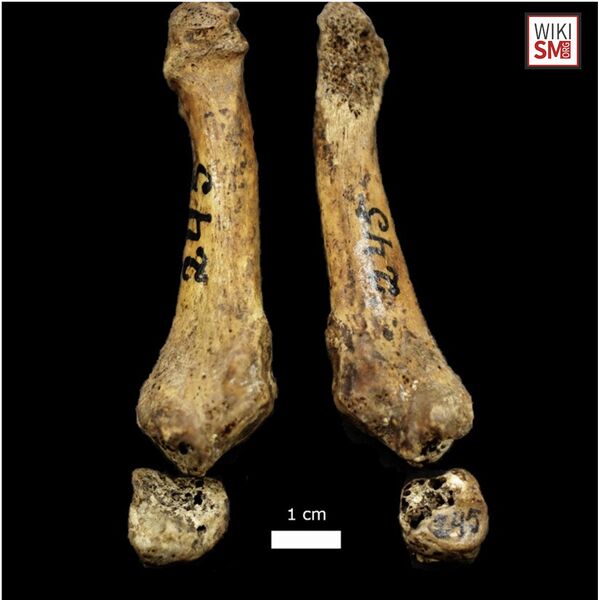 File:Os Vesalianum bone anatomy.jpeg