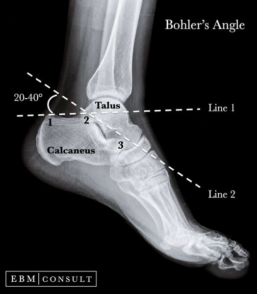 File:Bohlers angle.jpg