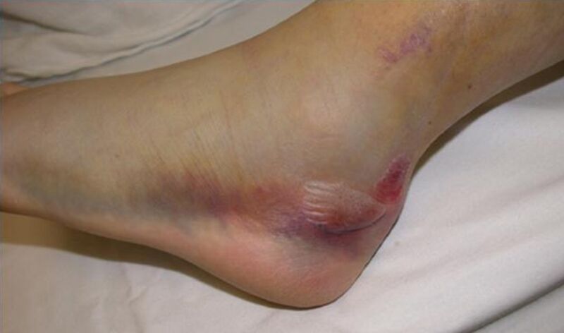 File:Calcaneus fracture clinical.jpg