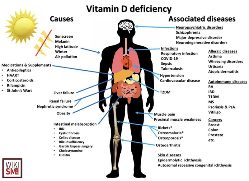 File:Vitamin d deficiency.jpeg