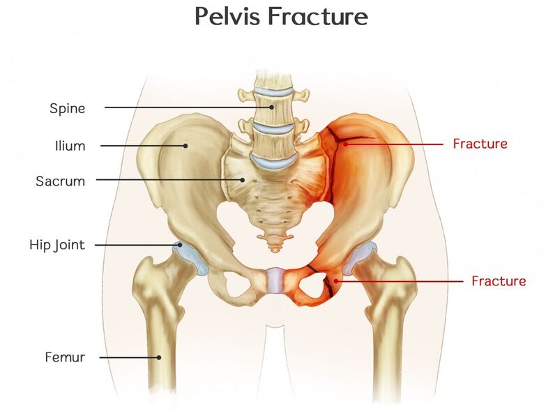 File:Pelvis fracture.jpg
