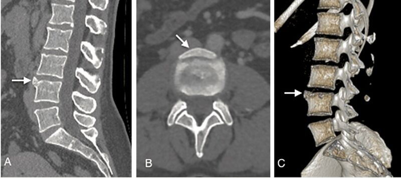 File:Limbus vertebra.jpg