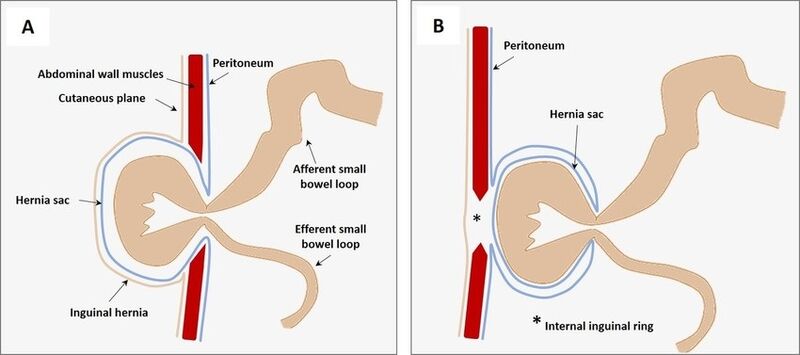 File:Sagittal image inguinal hernia.jpg