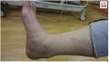 Posteromedial swelling of the Achilles tendon due to tendinopathy.[3]