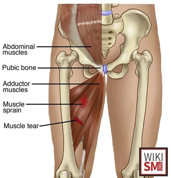 File:Adductor strain.jpeg