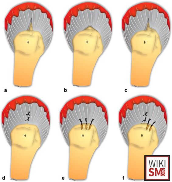 File:Banklart lesion surgical repair.jpeg