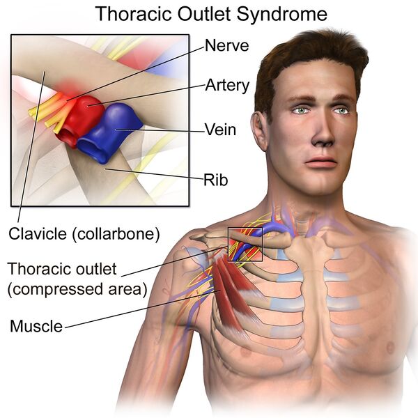 File:Thoracic outlet syndrome.jpg