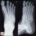 Os vasalianum of the right foot was initially confused for a fifth metatarsal fracture[3]