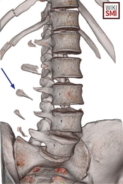 File:CT transverse process fractures.jpeg