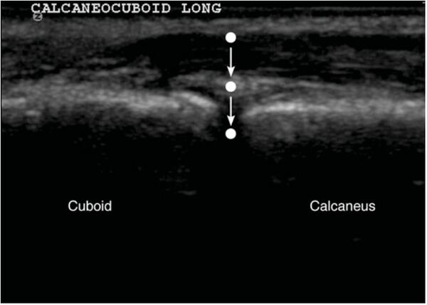 Calcaneocuboid Injection - WikiSM (Sports Medicine Wiki)