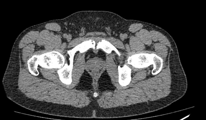 File:Pelvis CT Osteitis Pubis.jpg