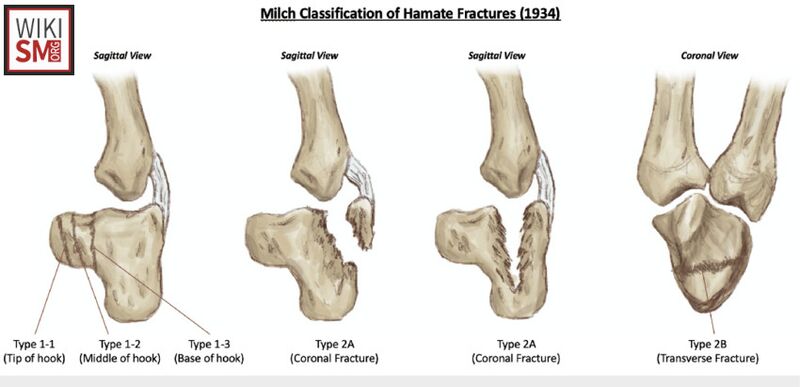 File:Hamate fracture milch classification.jpeg