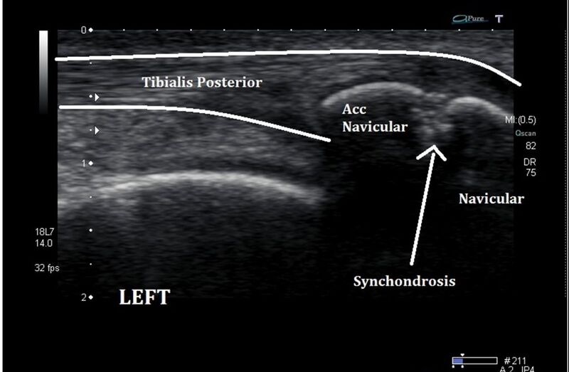 File:Os naviculare ultrasound.jpg