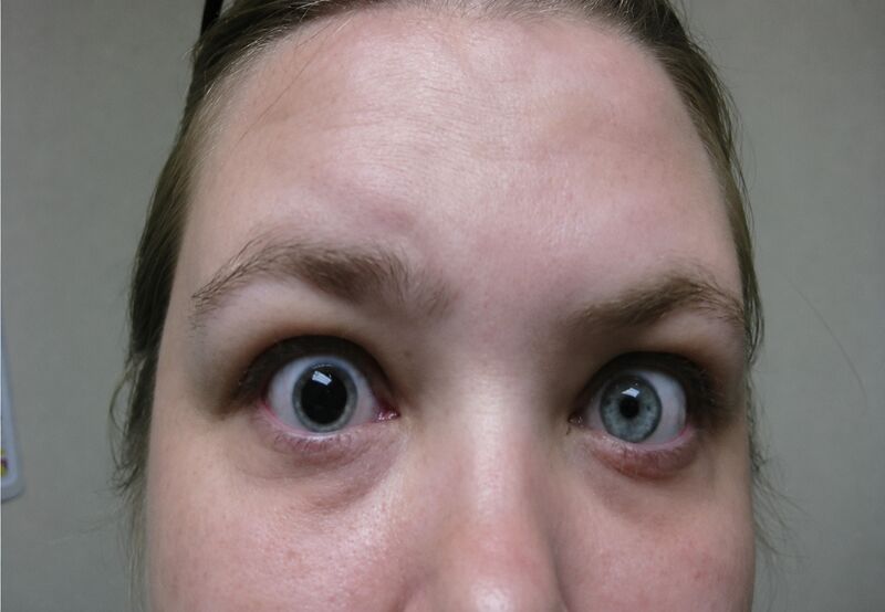 File:Hutchinson pupil clinical.jpeg