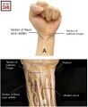 The surface anatomy of the flexor carpi radialis and palmaris longus upon palmar flexion. The dissection of the cadaver reveals flexor carpi radialis, palmaris longus, and the median nerve[2]