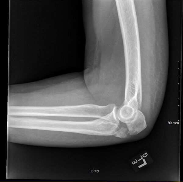File:Elbow xray olecranon fracture.jpg