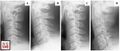 Representative radiographs of subtypes of ossification of posterior longitudinal ligament.[4]