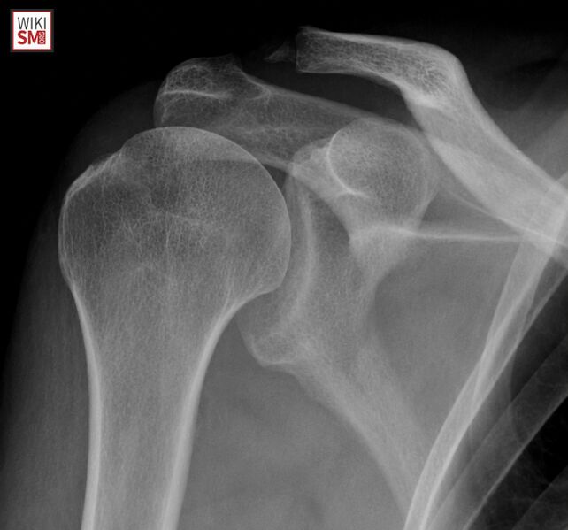 File:Distal Clavicle Osteolysis xray.jpeg