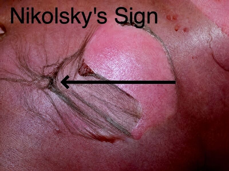 File:Nikolsky's sign.jpg