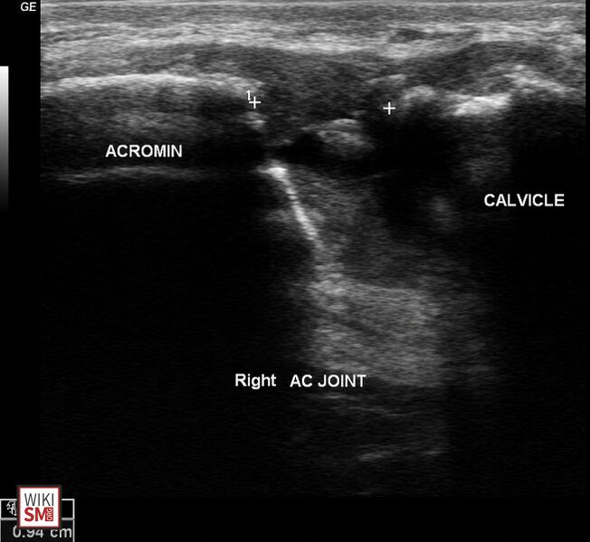 File:Distal Clavicle Osteolysis ultrasound.jpeg