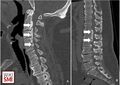 (A) Ossification of the posterior longitudinal ligament (OPLL) in the cervical spine (white arrow). (B) OPLL from the lower thoracic spine to the lumbar spine (white arrow).[3]