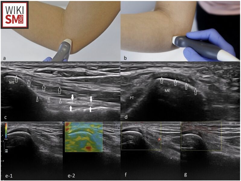 File:Medial epicondylitis ultrasound.jpeg