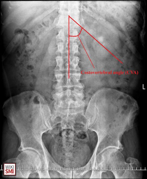 File:Xray costovertebral angle.jpeg
