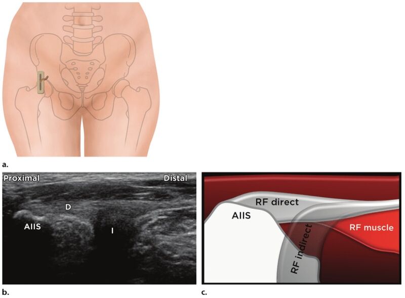 File:Rectus femoris ultrasound.jpg