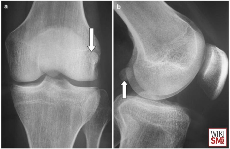 File:Cyamella accessory bone.jpeg