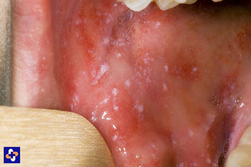 File:Koplik spots.jpeg