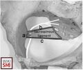 Pudendal nerve (PN) relations. a, Ischial spine to PN; b, distance between superior attachments of sacrospinous ligament; c, distance between inferior attachments of sacrospinous ligament[1]