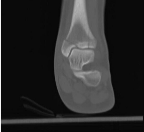 Distal Tibia Fracture - WikiSM (Sports Medicine Wiki)