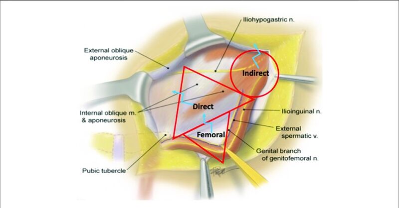 File:Inguinal hernia incision.jpg