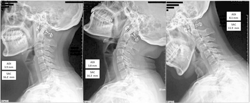 File:Atlantoaxial dislocation xray.jpg