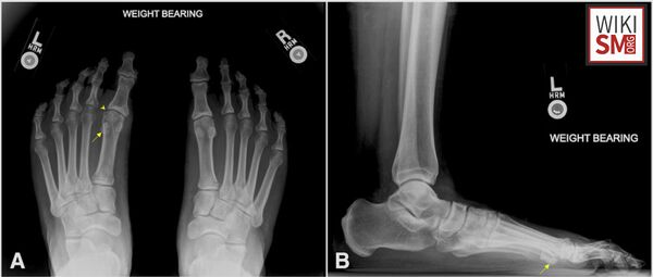 Turf Toe - WikiSM (Sports Medicine Wiki)