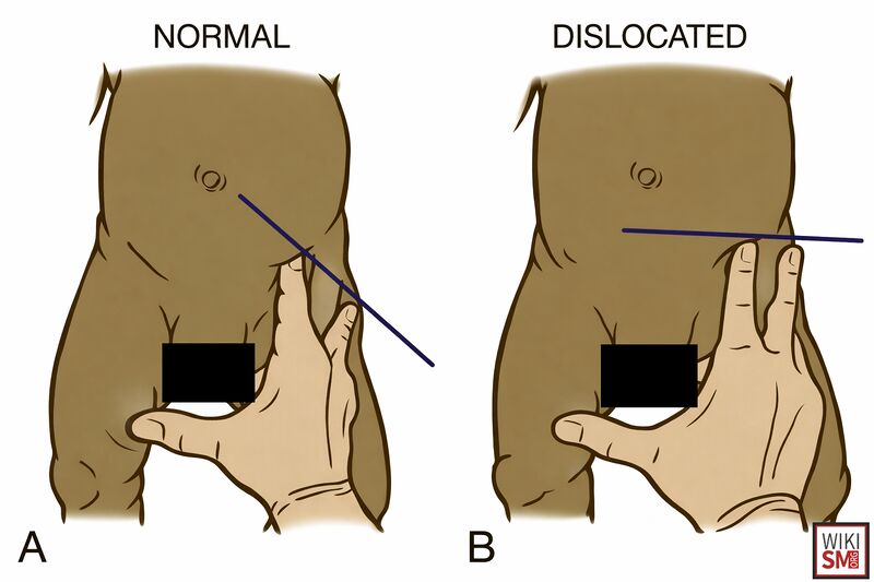 File:DDH klisic test hip.jpeg