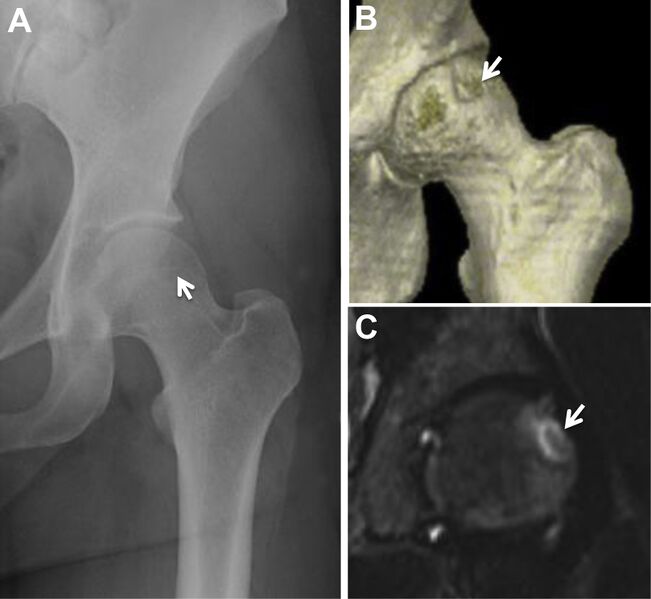 File:Hip osteochondral lesion left.jpg