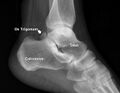 Os trigonum seen on lateral ankle radiograph[5]
