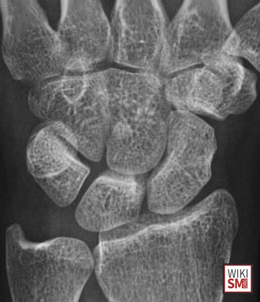 File:Capitate hamate coalition xray.jpeg