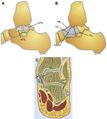 Deltoid ligament complex including the posterior tibiotalar ligament[1]