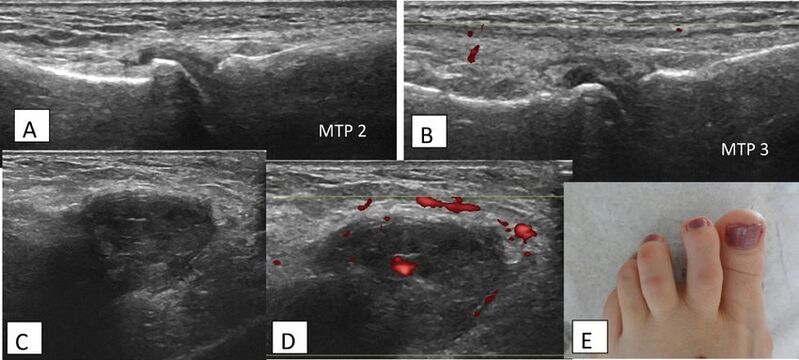 File:Intermetatarsal bursitis.jpg