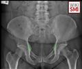 Bilateral ischial spine sign[2]