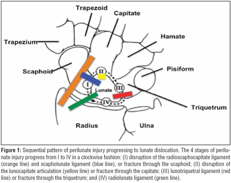 File:Pathophysiology of lunate dislocation.jpg